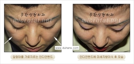 [두한성형외과 경쟁력 귀족성형] - [3차원 입체 미세지방이식 귀족수술 + 인디언밴드 교정] 관련 이미지 21