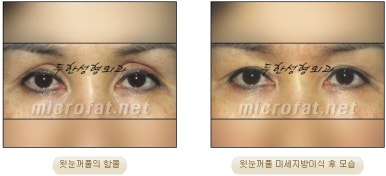 [Doohan Plastic Surgery Autologous Fat Grafting] - [Sunken Eye Fat Grafting] image 10