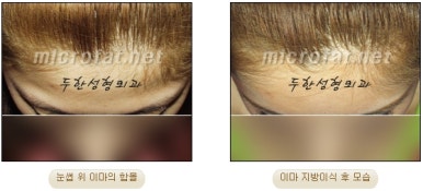 [Duhan Plastic Surgery Forehead Surgery] - [Forehead Fat Grafting for Forehead Surgery] image 13