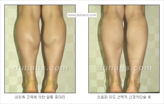 [두한성형외과 경쟁력 멀티종아리성형] - [종아리 퇴축수술 방법들의 문제점] 관련 이미지 10