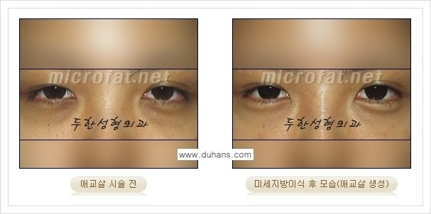 [두한성형외과 경쟁력 눈밑성형] - [애교살과 다크써클과의 관계] 관련 이미지 15