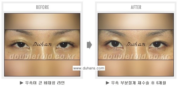 [두한성형외과 쌍꺼풀 재수술] - [과도한 앞트임이 되어있을 경우의 문제] 관련 이미지 8