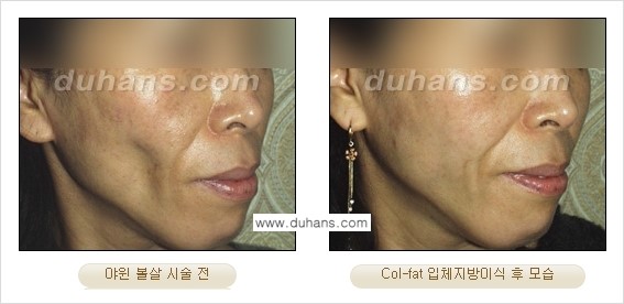 [두한성형외과 경쟁력 미세지방이식] - [탄력있는 피부와 윤곽을 만들어주는 Col-fat 지방이식] 관련 이미지 15
