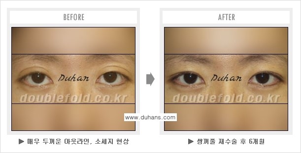 [두한성형외과] - [쌍꺼풀 재수술에서 매우높은 흉터선의 처리 문제] 관련 이미지 4