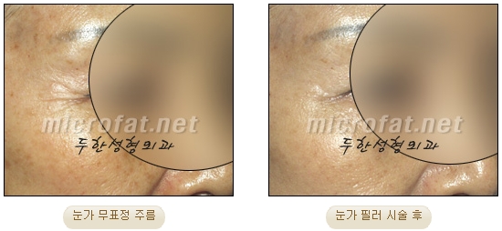 [Duhan Plastic Surgery Wrinkle Improvement] - [Wrinkle Filler Procedure] image 12