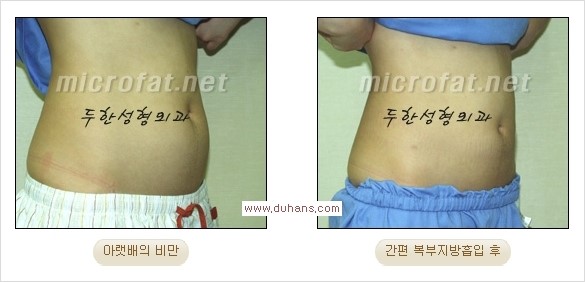 [두한성형외과 경쟁력 간편지방흡입] - [복부(뱃살) 비만 간편지방흡입] 관련 이미지 19