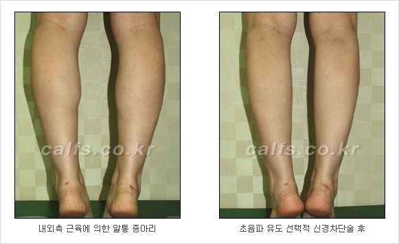[두한성형외과 경쟁력 종아리성형] - [초음파 유도 선택적 신경차단술 안내 ④] 관련 이미지 3