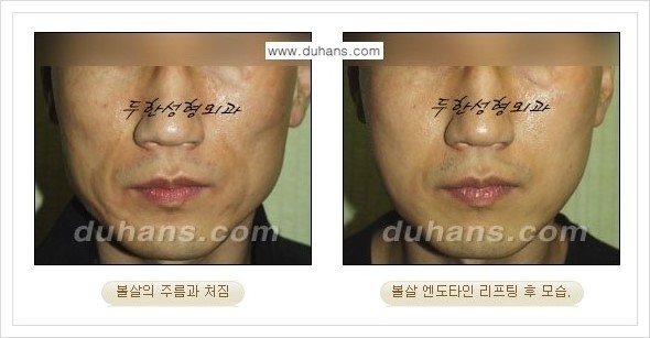 [두한성형외과 경쟁력 주름성형] - [엔도타인 리프팅 안내 ②] 관련 이미지 4