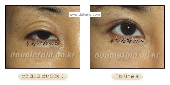 [두한성형외과 경쟁력 눈성형] - [재수술시 유의해야 할 사항과 성공 요건] 관련 이미지 5