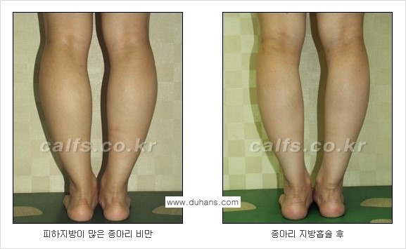 [두한성형외과 경쟁력 종아리성형] - [종아리 지방흡입 2.] 관련 이미지 8