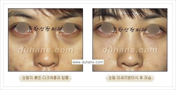 [두한성형외과 경쟁력 눈밑성형] - [꺼진 눈밑, 눈밑 함몰 주름선 눈밑 미세지방이식 안내] 관련 이미지 30