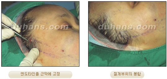두한성형외과 안티에이징 리프팅 - 엔도타인 리프팅 관련 이미지 13