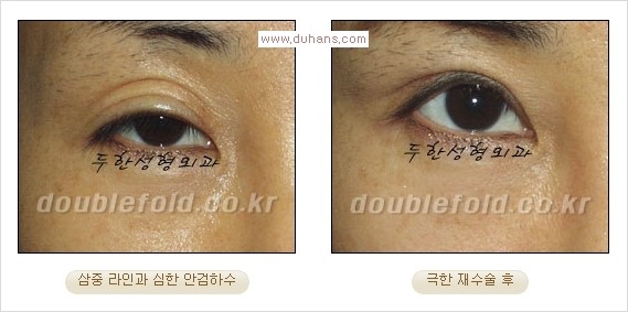 Dr. 컬럼 - 쌍꺼풀 재수술의 부작용을 최소화하는 극한 눈재수술 관련 이미지 6