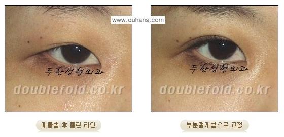 [두한성형외과 경쟁력 쌍꺼풀 재수술, 극한 눈재수술] - [풀린 쌍꺼풀의 완전절개법, 부분절개법 재수술 방법 안내] 관련 이미지 5