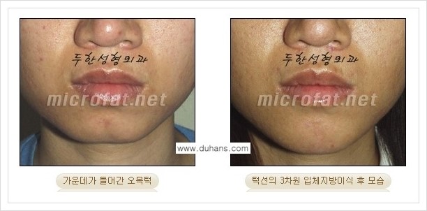 [두한성형외과 경쟁력 안면윤곽 교정] - [미세지방이식으로 무턱, 작은턱, 오목턱, 턱선의 비대칭 교정 안내] 관련 이미지 18