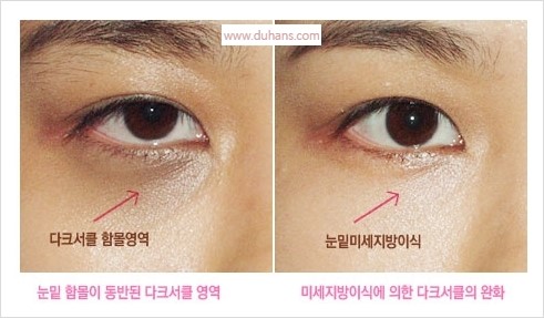 [두한성형외과 경쟁력 눈밑성형] - [눈밑 미세지방이식의 이해도 안내] 관련 이미지 13