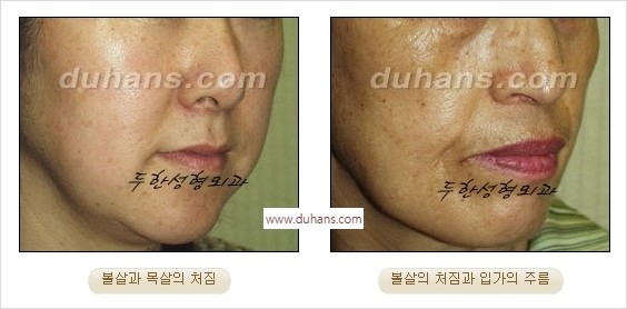 [두한성형외과 경쟁력 주름성형] - [간단하면서 자연스러운 주름제거 방법] 관련 이미지 1