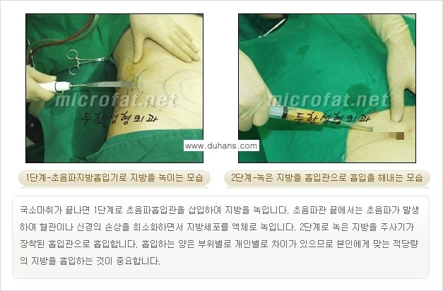 [두한성형외과 간편 지방흡입] - [복부(뱃살) 지방흡입 안내 ②] 관련 이미지 6