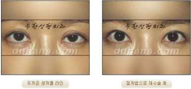 Best Place for Revision Eyelid Surgery, Duhan Plastic Surgery - Lowering Double Eyelid Line image 37