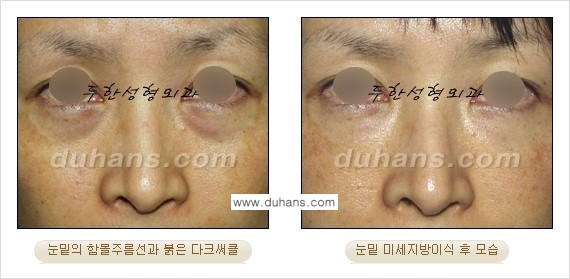 [두한성형외과 경쟁력 미세지방이식] - [다크써클 & 눈밑주름 미세지방이식 3.] 관련 이미지 8