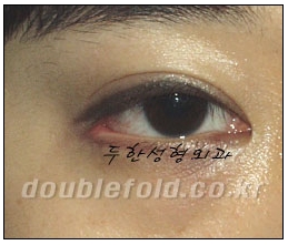 두한성형외과 쌍커풀 재수술 - 짝눈 눈매교정, 가성 안검하수 교정과 뒤밑트임 관련 이미지 61