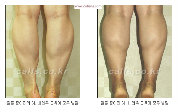 [두한성형외과 경쟁력 종아리성형 리더] - [종아리 성형 안내] 관련 이미지 1