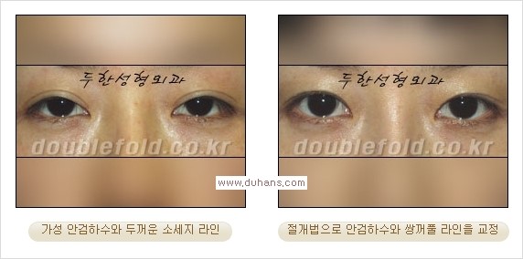 [두한성형외과 경쟁력 쌍꺼풀 재수술, 극한 눈재수술] - [안검하수 검사 및 수술방법 안내] 관련 이미지 12