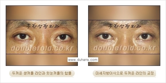 [두한성형외과 경쟁력 눈성형] - [미세지방이식으로 두꺼운 쌍꺼풀 라인의 교정 방법 안내] 관련 이미지 2
