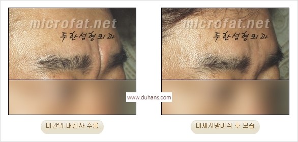 [두한성형외과 경쟁력 동안성형 리더] - ​[미간주름, 이마주름, 안검성형, 이마거상술, 눈썹거상술] 관련 이미지 8