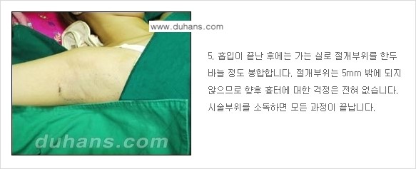 [두한성형외과 성형 FOCUS 지방흡입] - [액취증 - 다한증 초음파 컷터 지방흡입 ③] 관련 이미지 12