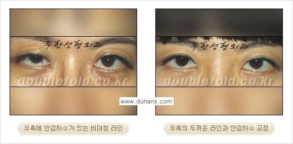 [두한성형외과 경쟁력 쌍꺼풀 재수술] - [비대칭(짝짝이) 쌍꺼풀 라인 교정하는 방법 안내 ①] 관련 이미지 11
