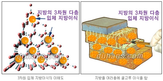 [두한성형외과 주름교정] - [주름개선 지방이식] 관련 이미지 1