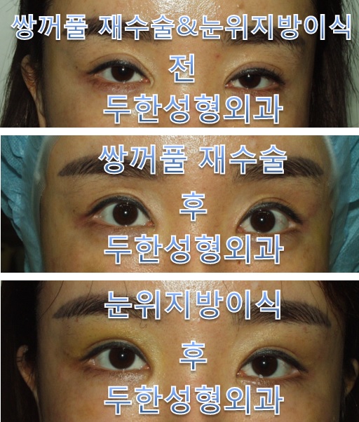 [두한성형외과 쌍꺼풀재수술,눈밑/눈위지방이식]-[#라인낮추기 #비대칭 #함몰눈 #꺼지눈] 관련 이미지 1