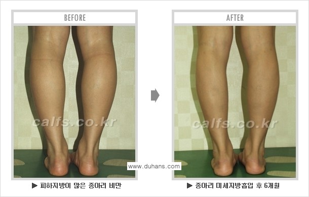[두한성형외과 매력적인 종아리 만들기!] - [정교한 흡입 - 미세흡입관 지방흡입술 3.] 관련 이미지 12
