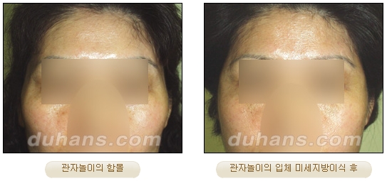 [Duhan Plastic Surgery Facial Autologous Fat Grafting] - [Fat Grafting Guide] image 5