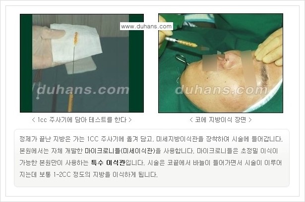 [두한성형외과 경쟁력 미세지방이식] - [코 미세지방이식 안내] 관련 이미지 7