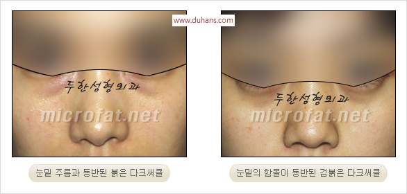 [두한성형외과 경쟁력 눈밑성형 리더] - [윗눈꺼풀 지방제거, 눈밑지방제거, 눈밑지방재배치, 눈밑지방이식 안내] 관련 이미지 12