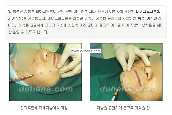 [두한성형외과 경쟁력 미세지방이식] - [부드럽고 아름다운 얼굴선 얼굴 미세지방이식 과정] 관련 이미지 9