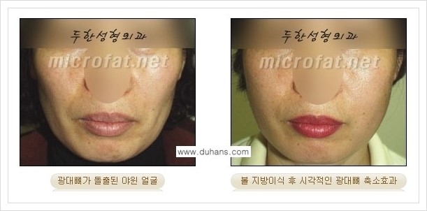 ⁠⁠[두한성형외과 경쟁력 볼살지방이식] - [심하게 야윈 주름이 있는 얼굴, 역삼각형 협소한 얼굴, 광대뼈가 돌출되어 보이는 경우 안내] 관련 이미지 16