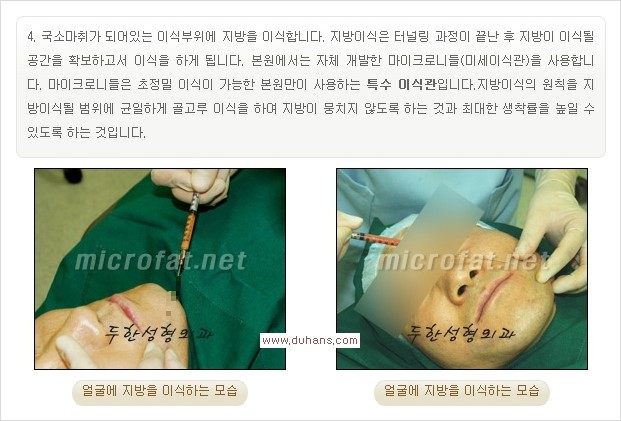 [두한성형외과 경쟁력 미세지방이식] - [타병원에서의 미세지방이식 이후 부작용 교정의 대상 안내] 관련 이미지 20
