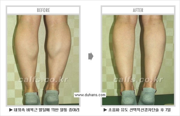 Dr. 컬럼 - 멀티 종아리 성형, 초음파 유도 비절개 선택적 신경차단술 관련 이미지 3