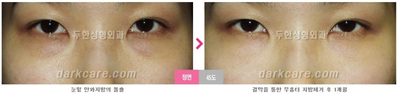 [두한성형외과 다크서클] - [다크서클 전후사진 검증] 관련 이미지 99