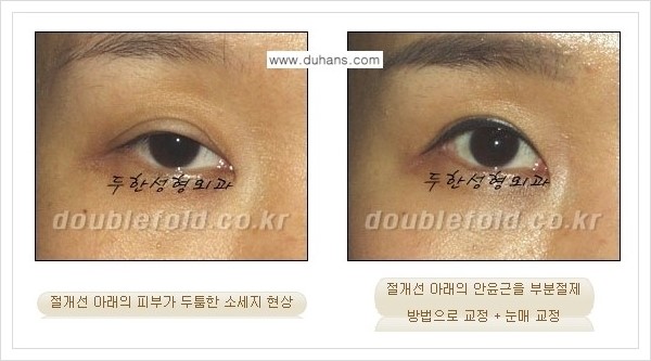 [두한성형외과 경쟁력 쌍꺼풀  재수술, 극한 재수술] - [절개선 아래가 두툼한(소세지 쌍꺼풀) 현상 교정 안내] 관련 이미지 6