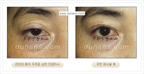 [두한성형외과 경쟁력 망가진 눈 복원수술] - [두꺼운 라인을 교정하는 극한 재수술(Extreme Reoperation) 안내] 관련 이미지 2