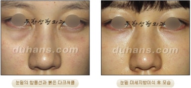 두한성형외과 눈밑성형 - 눈밑지방제거, 눈밑주름, 눈밑지방재배치 관련 이미지 66