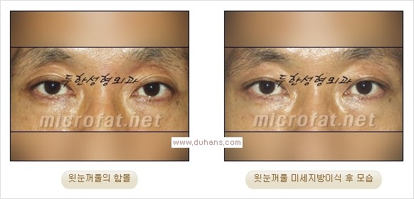 [두한성형외과 경쟁력 쌍꺼풀 재수술, 극한 눈재수술] - [어색한 쌍꺼풀 라인을 교정하는 윗눈꺼풀 미세지방이식] 관련 이미지 21