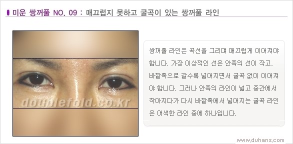 [두한성형외과 경쟁력 쌍꺼풀 재수술, 극한 눈재수술] - [Dr. 컬럼 - 재수술의 목표] 관련 이미지 12