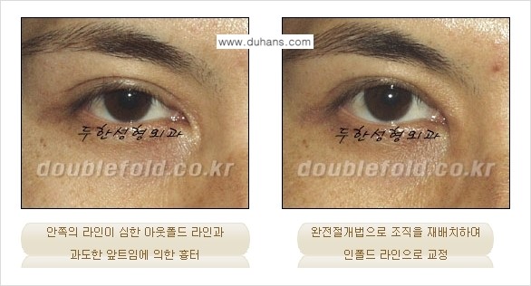 [두한성형외과 경쟁력 쌍꺼풀 재수술, 극한 눈재수술] - [심한 아웃폴드 라인을 인폴드 라인으로 교정 방법 안내] 관련 이미지 8