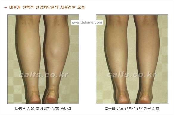 [두한성형외과 경쟁력 종아리성형] - [초음파 유도 선택적 신경차단술 안내 ③] 관련 이미지 6