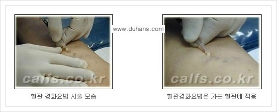 [두한성형외과 경쟁력 멀티종아리성형] - [나에게 맞는 종아리 시술 방법과 종류 안내 ③] 관련 이미지 12
